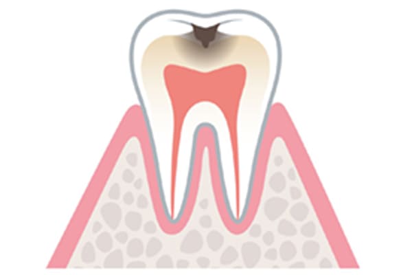 痛みはないが進行したむし歯