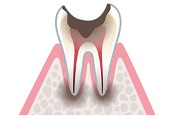 抜歯しなくてはいけないむし歯