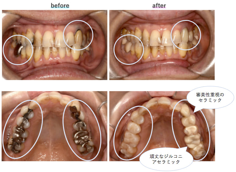 銀歯を白い歯に