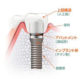 インプラントの構造