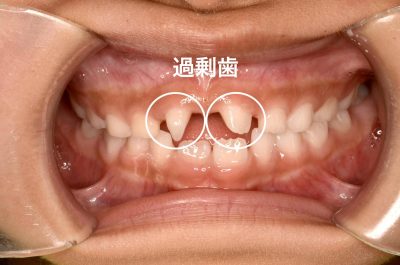 過剰歯とは？子供の過剰歯の抜歯をすすめる６つの理由と費用・流れ - 東戸塚の歯医者  おかざき歯科クリニック｜横浜市戸塚区のインプラント、セラミック、審美治療